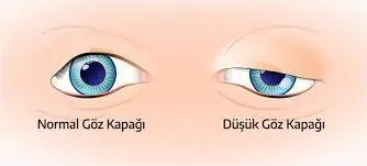 Çocuklarda göz kapak sarkması!