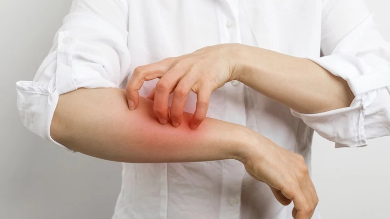 Anafilaksi son 10 yılda 7 kat arttı 