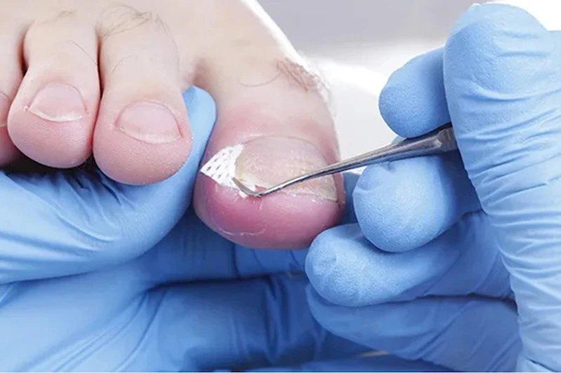 Tırnak mantarını önlemek için yapılması gerekenler