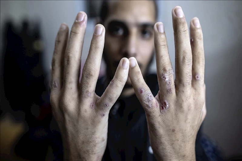 Siyonist rejim, Filistinli esirleri kasten enfekte ederek sistematik işkenceye devam ediyor