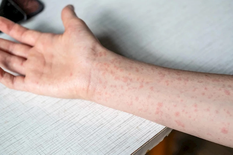 ABD’de kızamık vakaları 33 yılın zirvesinde