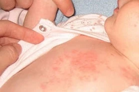 Çocuklarda isilik tehlikesine dikkat