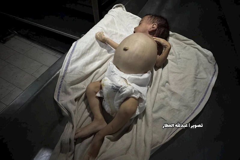 Gazze’de açlıktan şehid olanların sayısı 114’ü çocuk, 281’e yükseldi