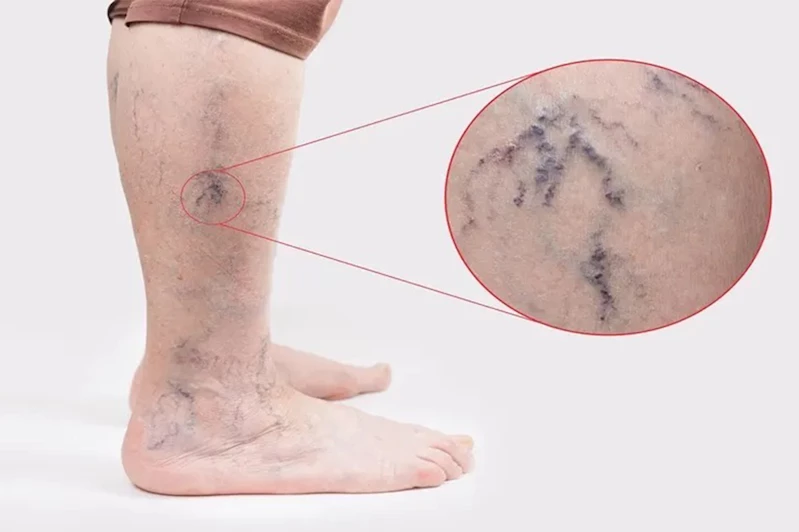 Şanlıurfa’da varis tedavisinde modern yöntemler uygulanıyor