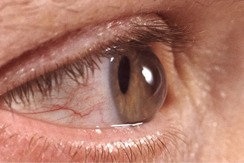 Gözü sık sık ovuşturmak görme kaybına yol açabilir